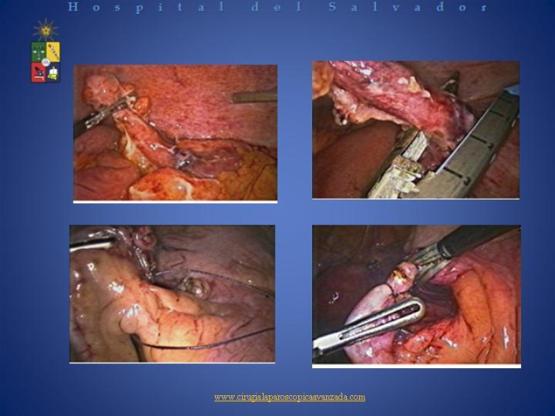 Diapositiva 20 de Laparoscopía Diagnóstica