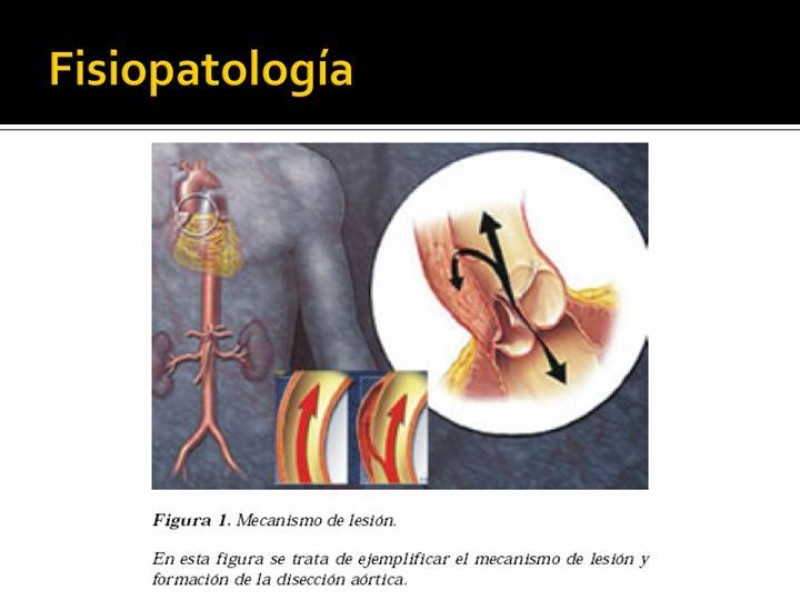 Diapositiva 4 de Disección de Aorta Torácica