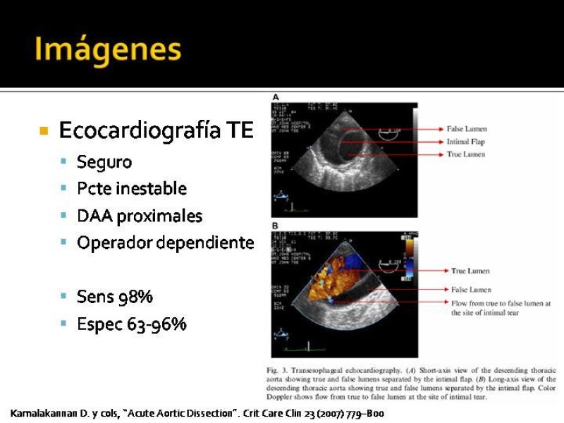 Diapositiva 21 de Disección de Aorta Torácica