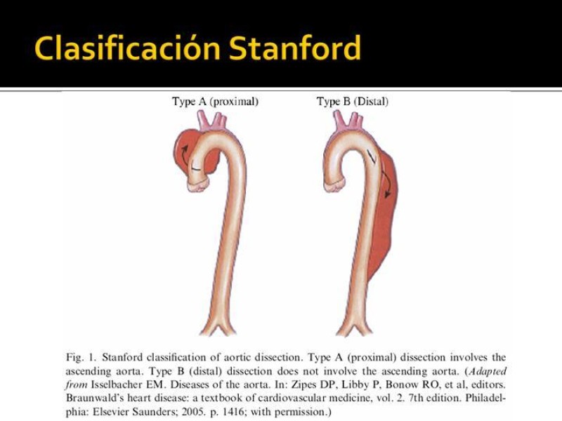 Diapositiva 13 de Disección de Aorta Torácica