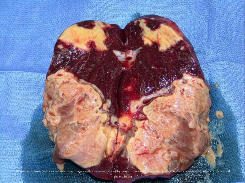 Diapositiva 5 de Abscesos Esplénicos