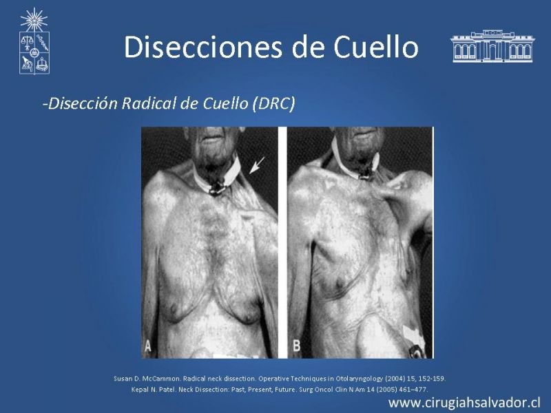 Diapositiva 14 de Disecciones ganglionares de cuello