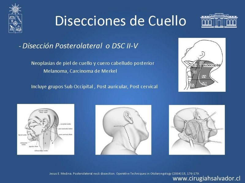 Diapositiva 20 de Disecciones ganglionares de cuello