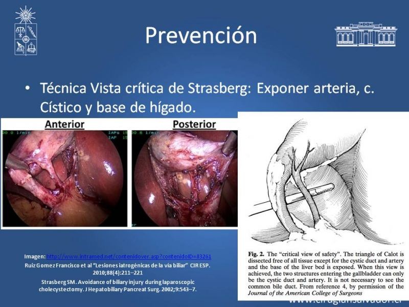 Diapositiva 10 de Prevención de Lesión Via Biliar en Colecistectomía 