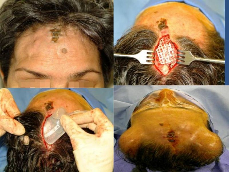 Diapositiva 16 de Expansores de Tejido