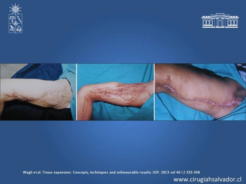 Diapositiva 21 de Expansores de Tejido