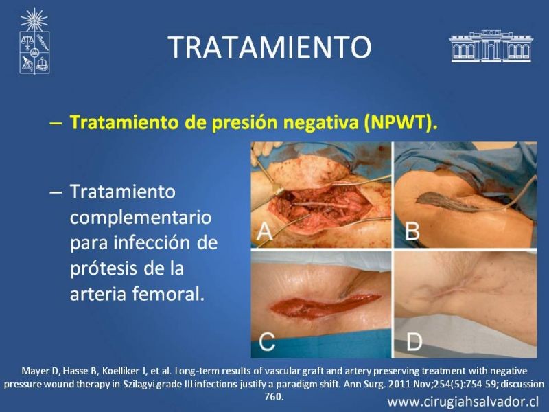 Diapositiva 35 de Infección de prótesis vasculares
