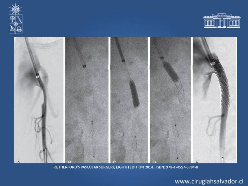 Diapositiva 29 de Isquemia mesentérica
