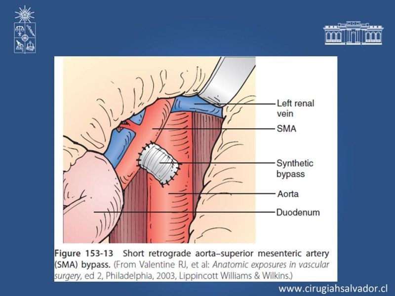 Diapositiva 22 de Isquemia mesentérica