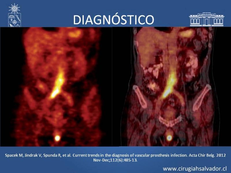 Diapositiva 30 de Infección de prótesis vasculares