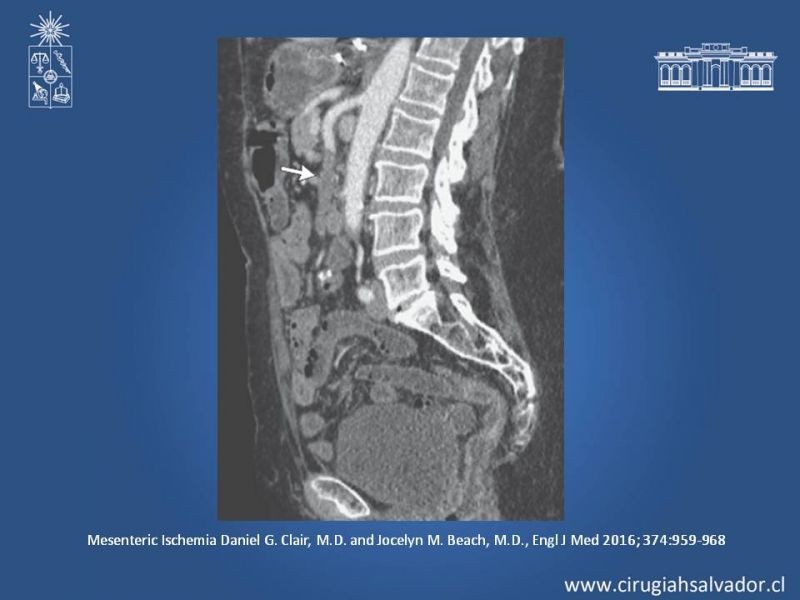 Diapositiva 15 de Isquemia mesentérica