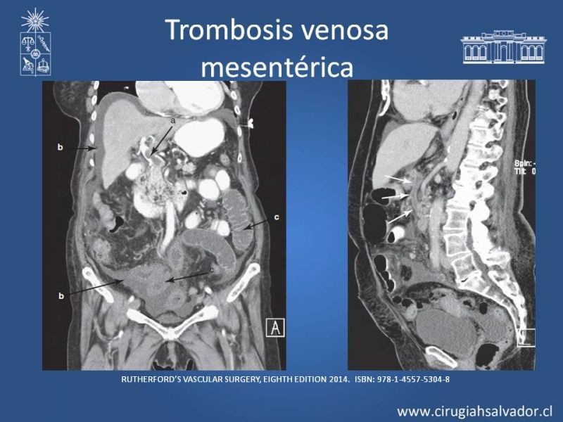 Diapositiva 33 de Isquemia mesentérica