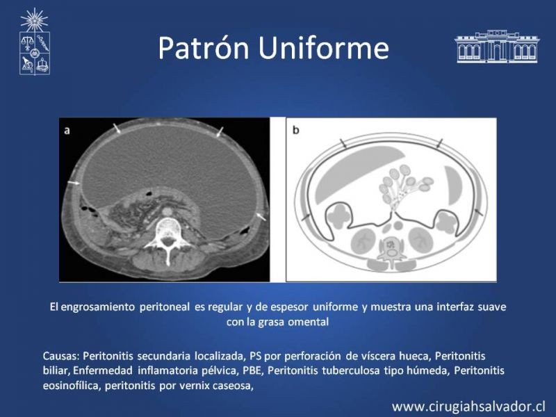 Diapositiva 12 de Peritonitis Secundaria y Terciaria