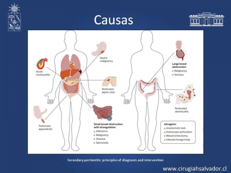 Diapositiva 6 de Peritonitis Secundaria y Terciaria