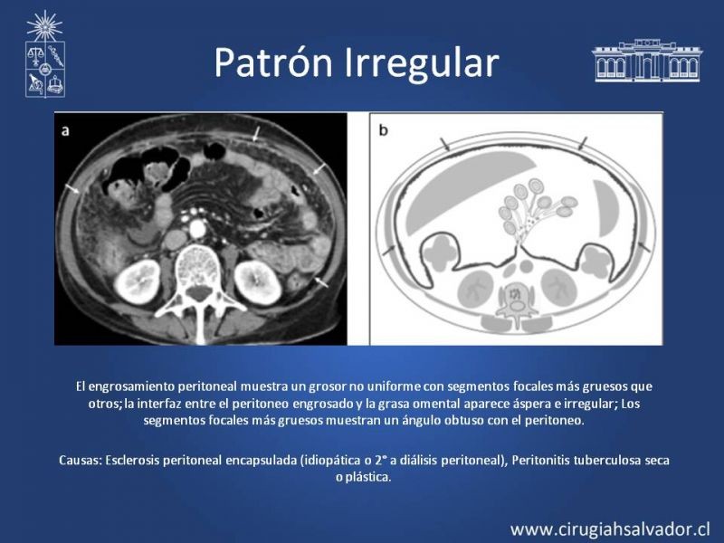 Diapositiva 13 de Peritonitis Secundaria y Terciaria