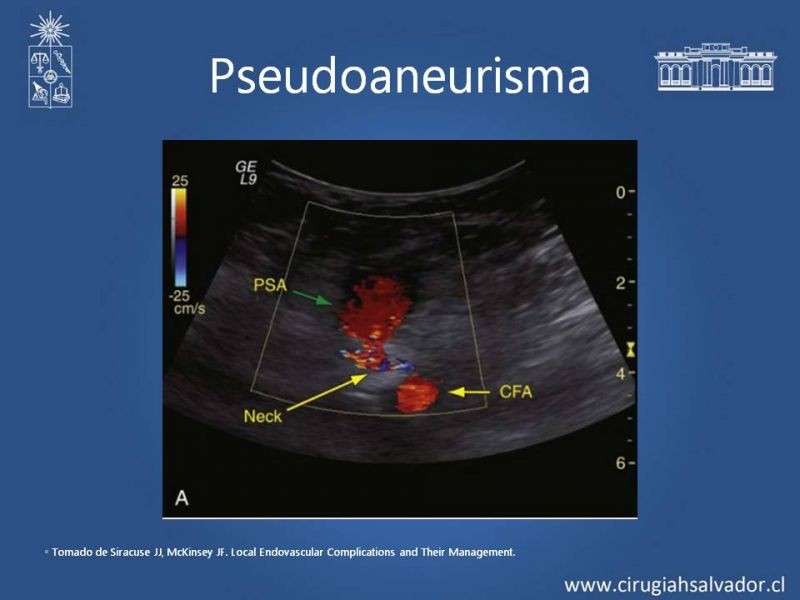 Diapositiva 14 de Complicaciones postoperatorias de abordajes quirúrgicos vasculares
