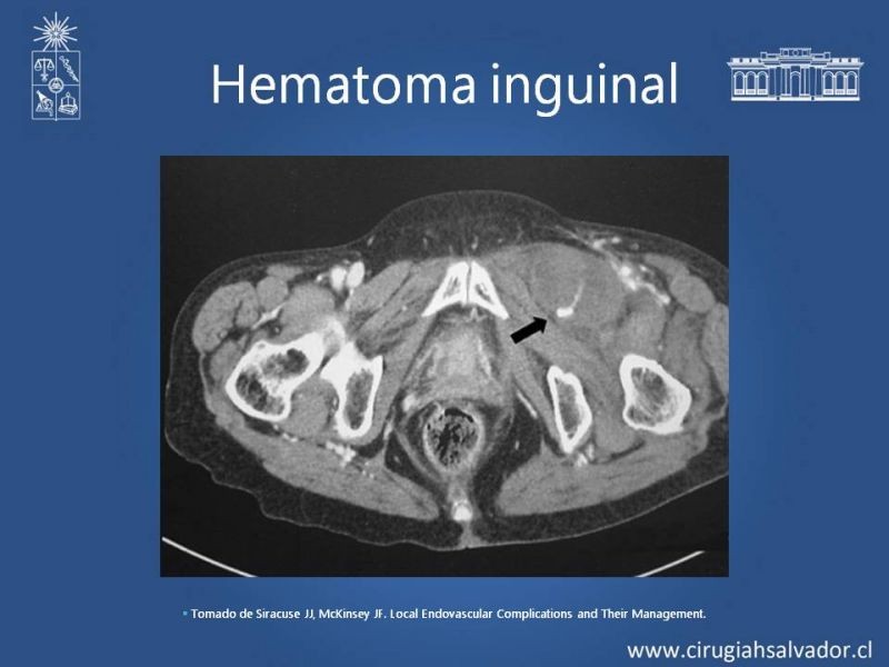 Diapositiva 4 de Complicaciones postoperatorias de abordajes quirúrgicos vasculares