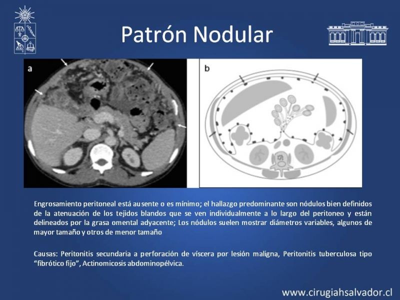 Diapositiva 14 de Peritonitis Secundaria y Terciaria