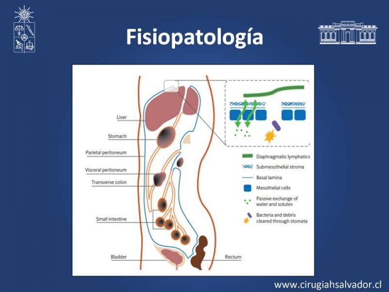 Diapositiva 7 de Peritonitis Secundaria y Terciaria