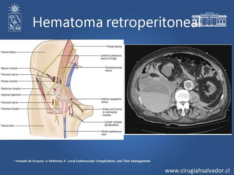 Diapositiva 7 de Complicaciones postoperatorias de abordajes quirúrgicos vasculares
