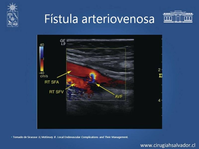 Diapositiva 11 de Complicaciones postoperatorias de abordajes quirúrgicos vasculares