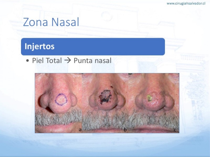 Diapositiva 27 de Tipos de Reconstrucción Facial