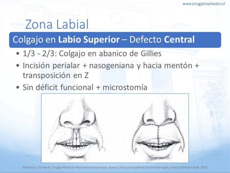 Diapositiva 38 de Tipos de Reconstrucción Facial