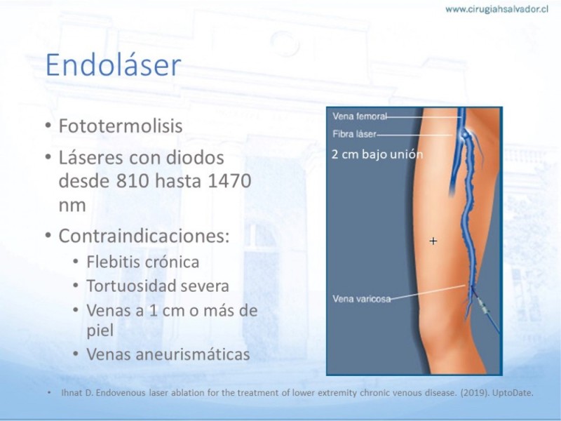 Diapositiva 18 de Safenectomía: Técnica y resultados a largo plazo