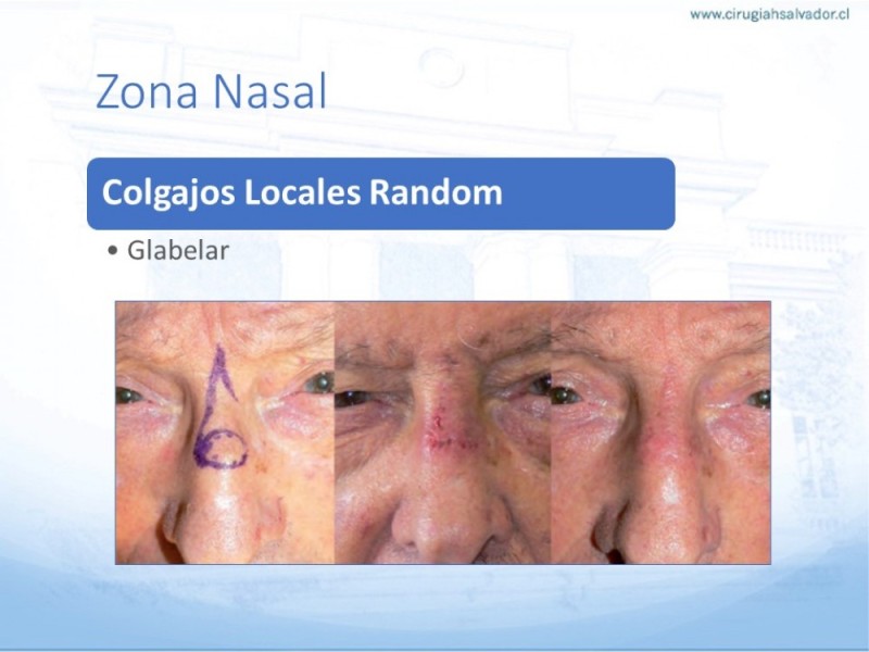 Diapositiva 30 de Tipos de Reconstrucción Facial