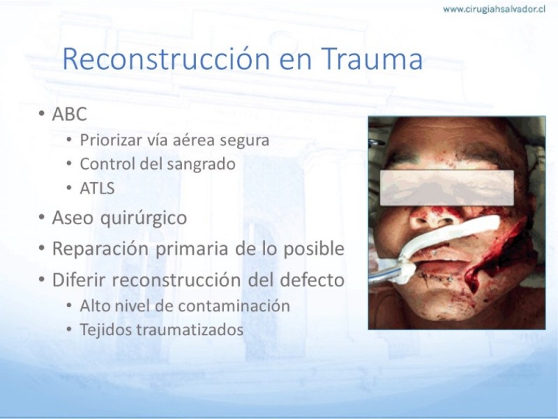 Diapositiva 6 de Tipos de Reconstrucción Facial