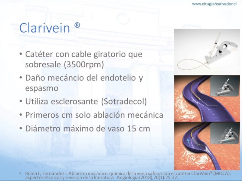 Diapositiva 21 de Safenectomía: Técnica y resultados a largo plazo