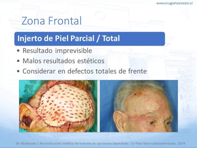 Diapositiva 18 de Tipos de Reconstrucción Facial