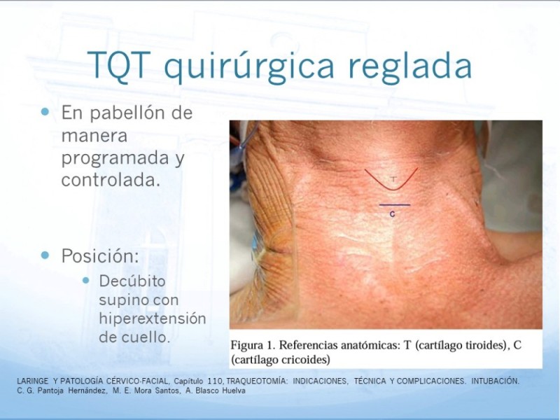 Diapositiva 12 de Traqueotomía: Indicaciones y técnica