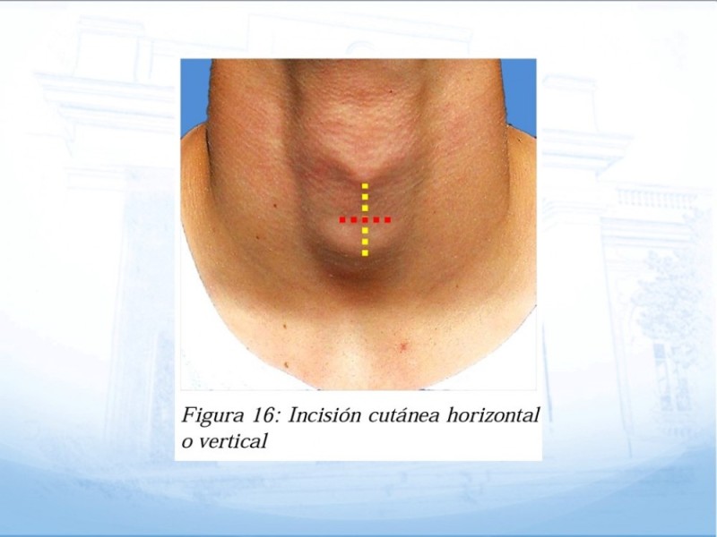Diapositiva 51 de Traqueotomía: Indicaciones y técnica