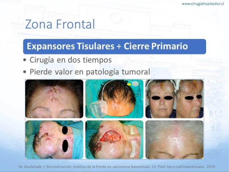 Diapositiva 17 de Tipos de Reconstrucción Facial