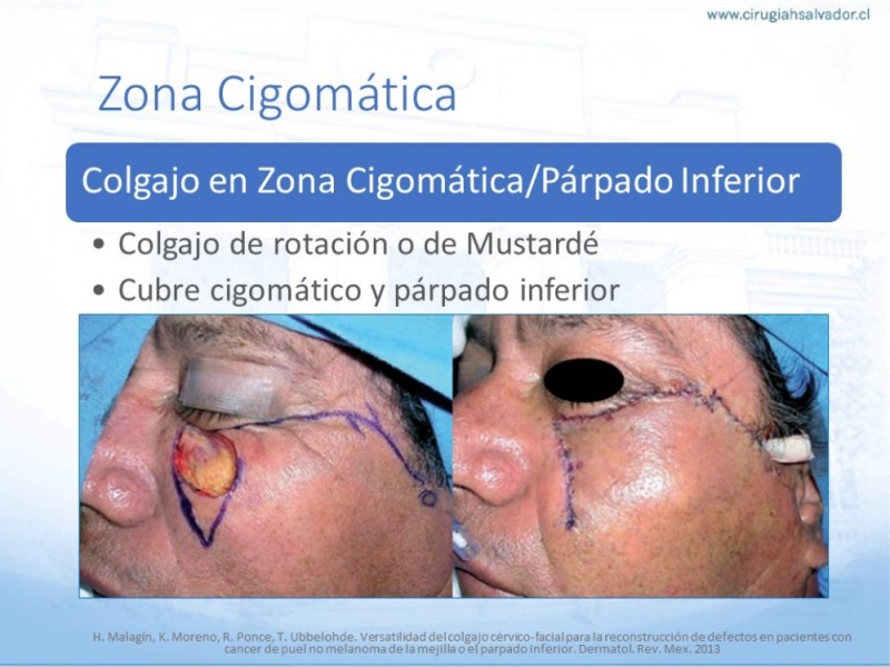 Diapositiva 48 de Tipos de Reconstrucción Facial