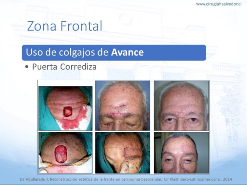 Diapositiva 19 de Tipos de Reconstrucción Facial