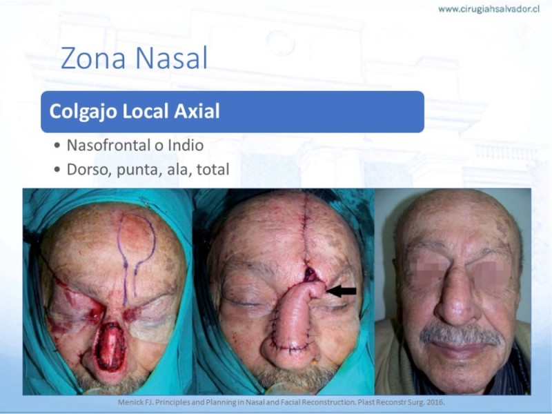 Diapositiva 32 de Tipos de Reconstrucción Facial