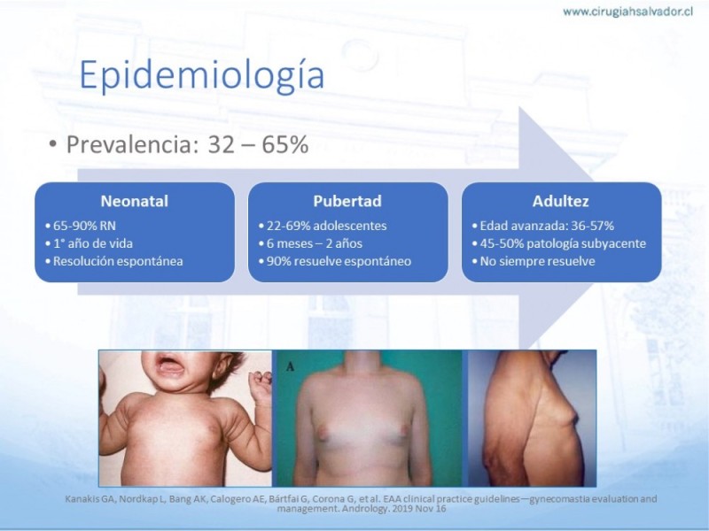 Diapositiva 3 de Ginecomastia