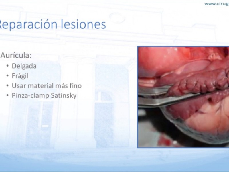 Diapositiva 23 de Trauma penetrante cardíaco