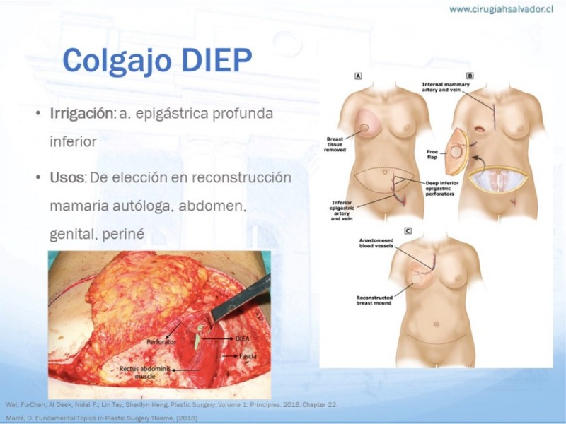 Diapositiva 12 de Colgajos MicroquirúrgicosColgajos Microquirúrgicos