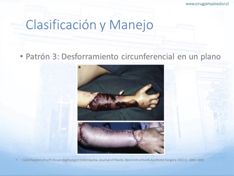 Diapositiva 11 de Desforramiento EEII