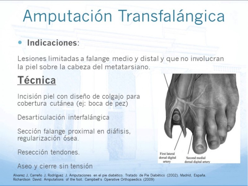 Diapositiva 5 de Técnica Quirúrgica Amputaciones Menores