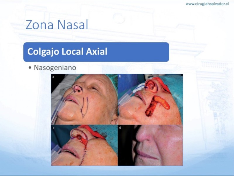 Diapositiva 33 de Tipos de Reconstrucción Facial