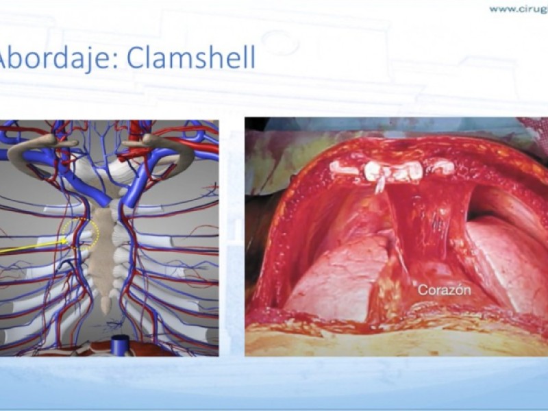 Diapositiva 19 de Trauma penetrante cardíaco