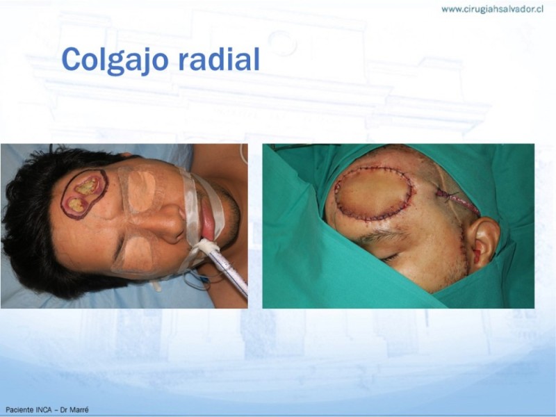 Diapositiva 17 de Colgajos MicroquirúrgicosColgajos Microquirúrgicos