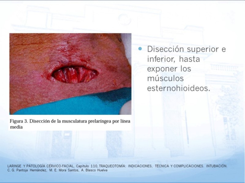 Diapositiva 14 de Traqueotomía: Indicaciones y técnica