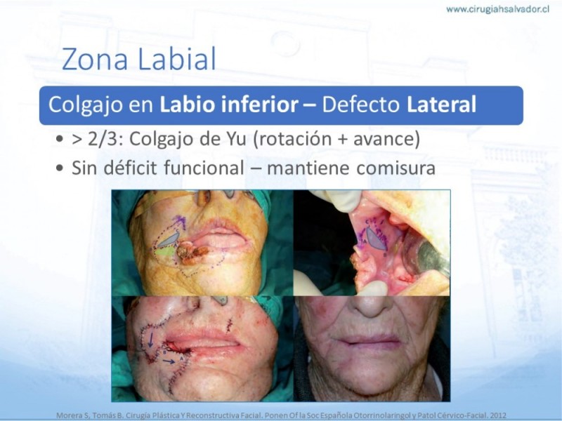 Diapositiva 42 de Tipos de Reconstrucción Facial