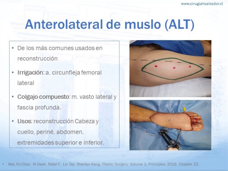 Diapositiva 11 de Colgajos MicroquirúrgicosColgajos Microquirúrgicos