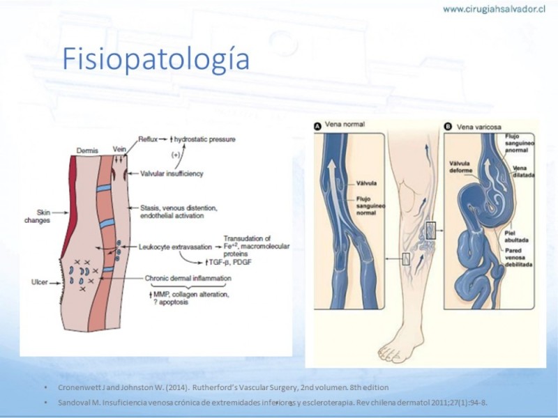Diapositiva 5 de Safenectomía: Técnica y resultados a largo plazo